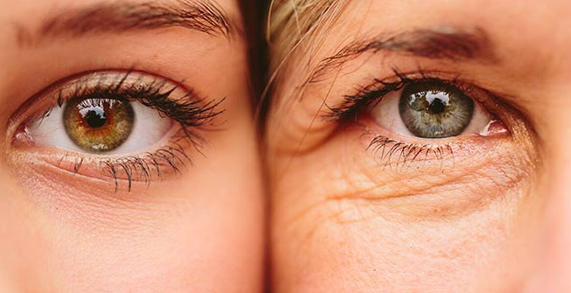 Signes externes de vieillissement cutané autour des yeux de deux femmes d'âges différents