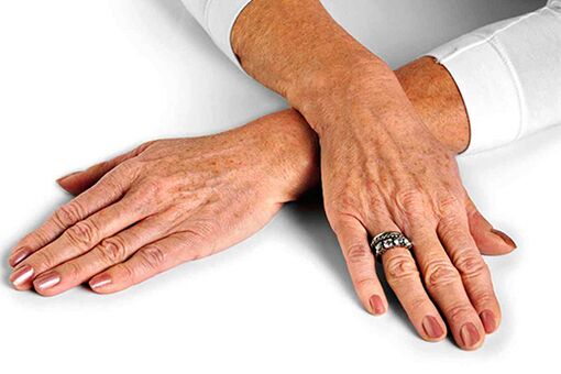 Les modifications de la peau des mains liées à l'âge nécessitent l'utilisation de techniques de rajeunissement
