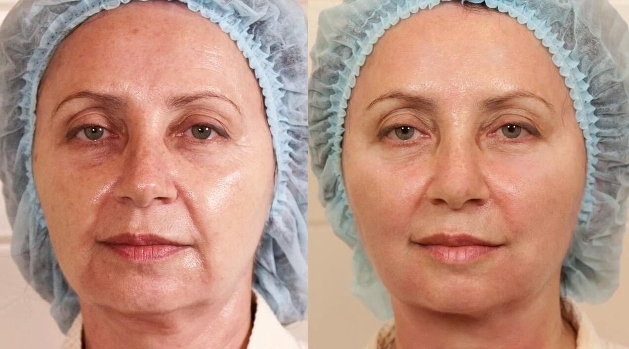 Photos avant et après la chirurgie plastique