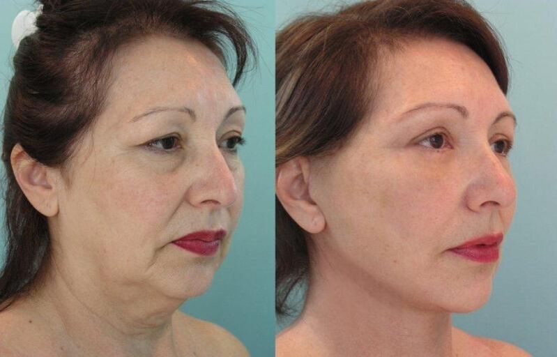 Utilisez la peau du visage raffermissante pour des résultats rajeunissants