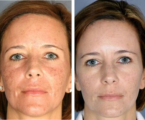 Avant et après la pyrolyse faciale