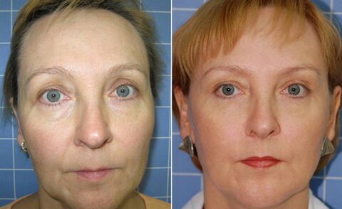Avant et après la réparation faciale fractionnée au laser