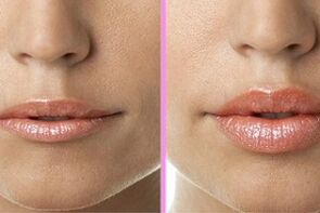 Avant et après la chirurgie de réparation des lèvres